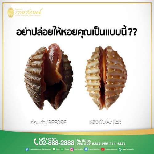 รีแพร์ เลอลักษณ์ 4 รีแพร์ เลอลักษณ์ 4