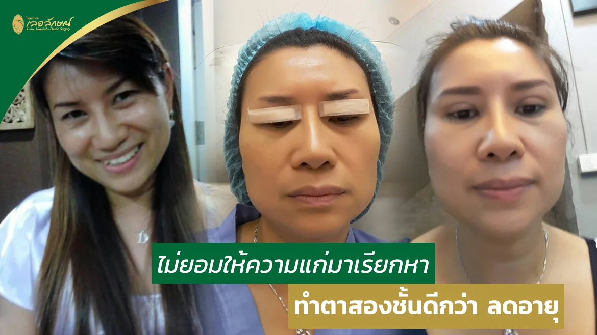 รีวิวตาสองชั้น) ทำตาสวย ลดอายุ , ที่เลอลักษณ์ , รีวิวโดยพี่แดงค่ะ - โรงพยาบาลเลอลักษณ์ ศัลยกรรมตกแต่ง เสริมความงาม เสริมจมูก เสริมหน้าอก ศัลยกรรมใบหน้า ดึงหน้า เสริมคาง ตัดแต่งหน้าท้อง เสริมสะโพก เสริมหน้าผาก ฉีดผิว โบท็อกซ์ รีวิวตาสองชั้น) ทำตาสวย ลดอายุ , ที่เลอลักษณ์ , รีวิวโดยพี่แดงค่ะ - โรงพยาบาลเลอลักษณ์ ศัลยกรรมตกแต่ง เสริมความงาม เสริมจมูก เสริมหน้าอก ศัลยกรรมใบหน้า ดึงหน้า เสริมคาง ตัดแต่งหน้าท้อง เสริมสะโพก เสริมหน้าผาก ฉีดผิว โบท็อกซ์