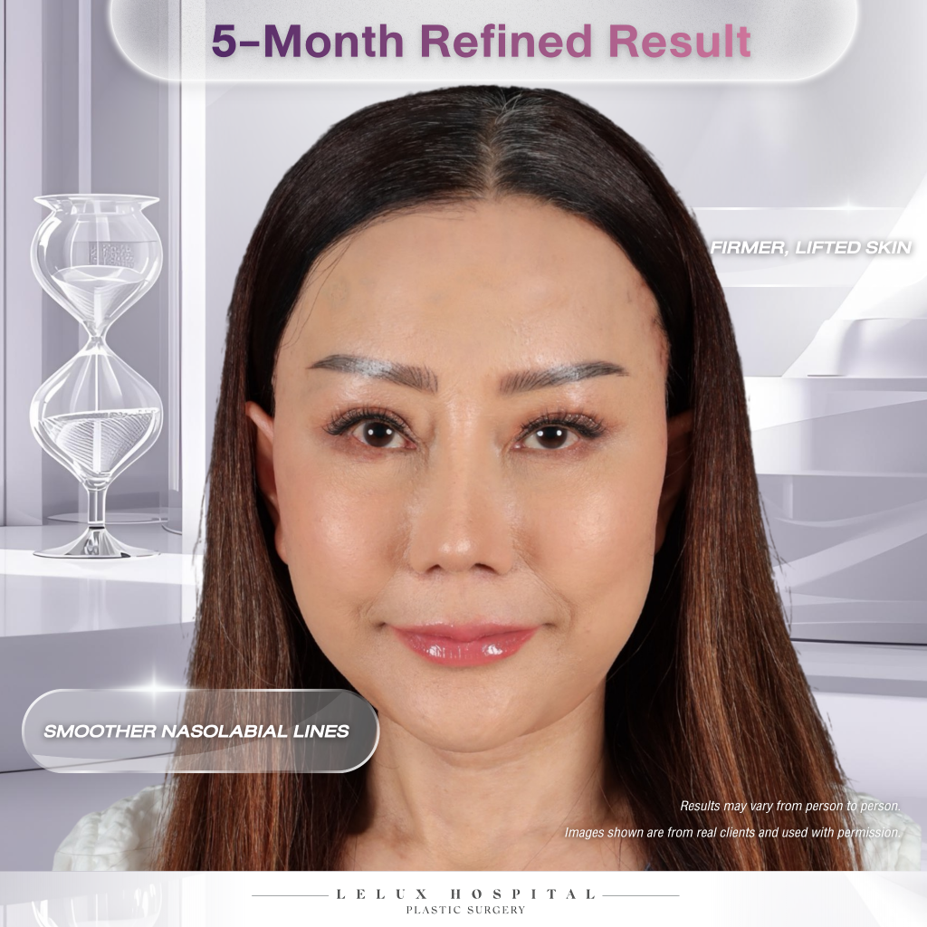 5-Month Refined Result
