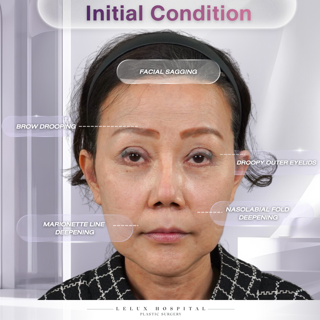 Understanding the Facial Aging Pattern