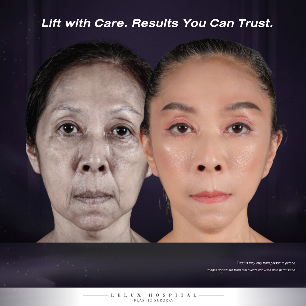 What Is Facelift Surgery