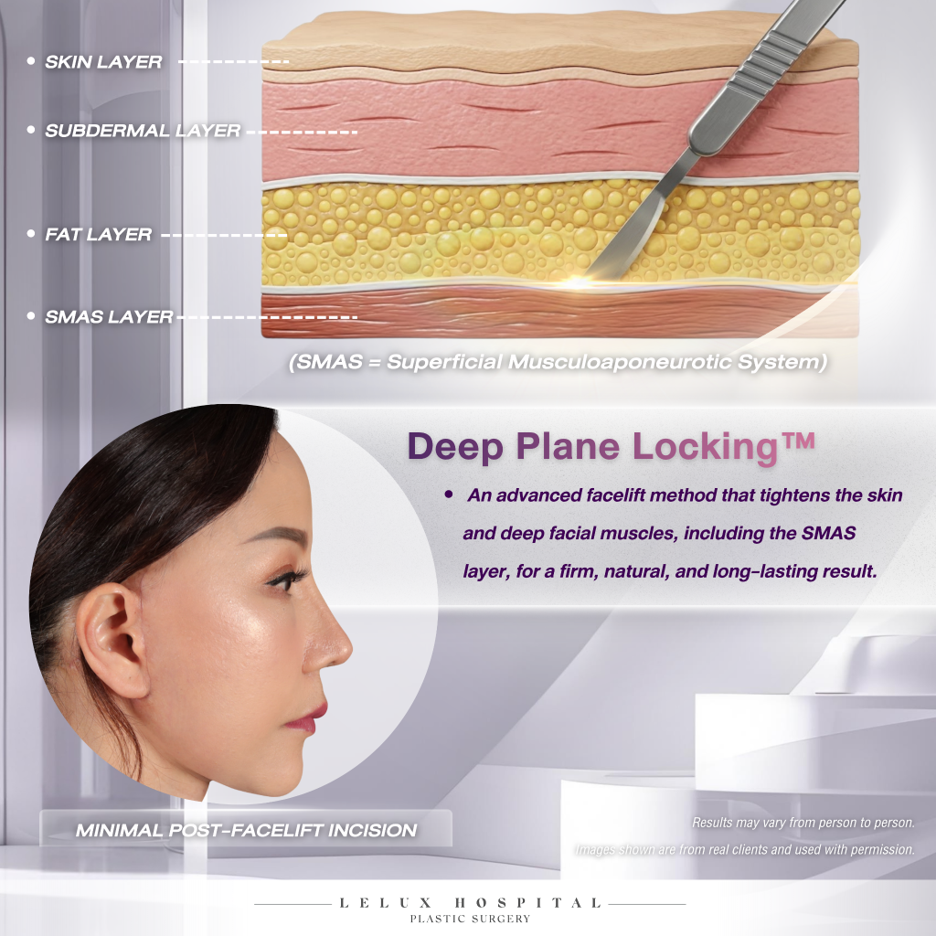 deep plane locking